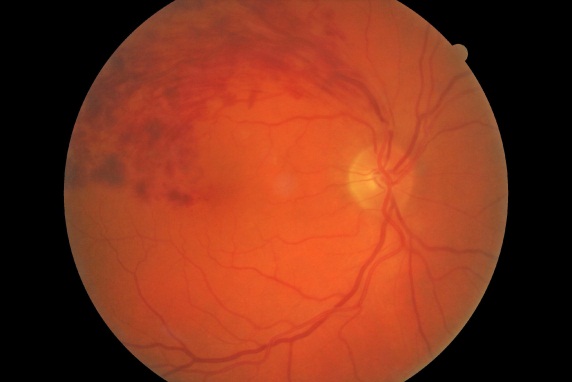 retinal exam branch vein occlusion