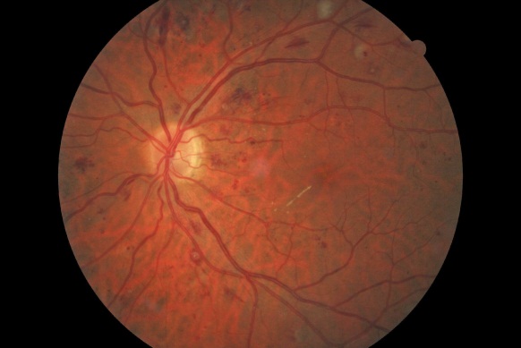 retinal exam diabetic retinopathy