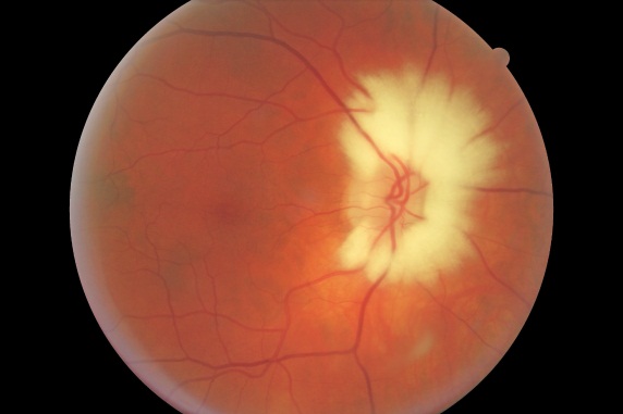 retinal exam myelinated nerve fibers
