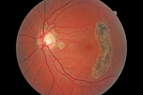 retinal exam retinal scar